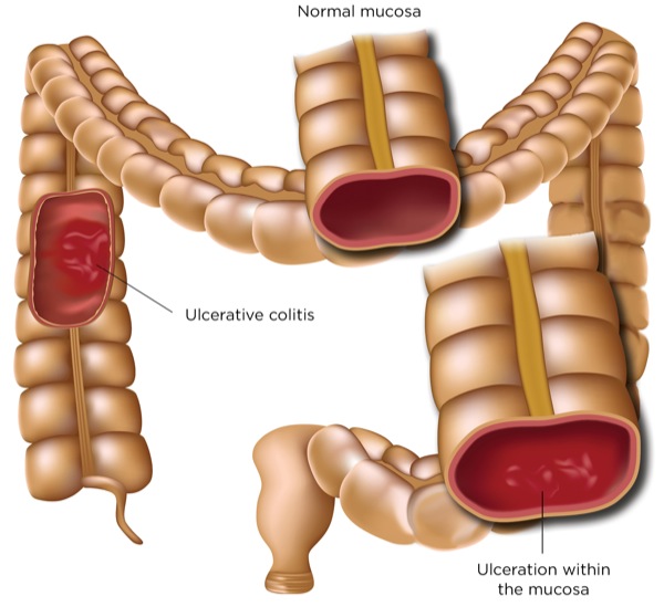 ulcerative colitis glp-1 Ulcerative Colitis: An Update On Diagnosis and Treatment