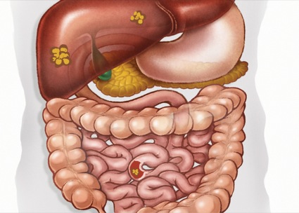 Novel Agent Reduces Bowel Movement Frequency in Carcinoid Syndrome