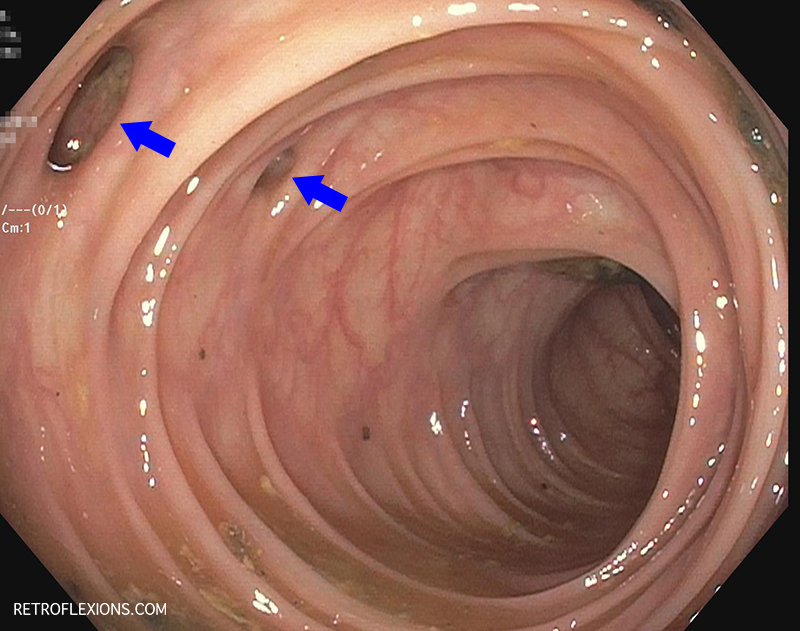 Can you eat seeds, nuts, and popcorn if you have diverticulosis? Can diet  prevent diverticulitis?