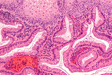 Argon Therapy Bests RFA After EMR for Barrett’s, Study Finds