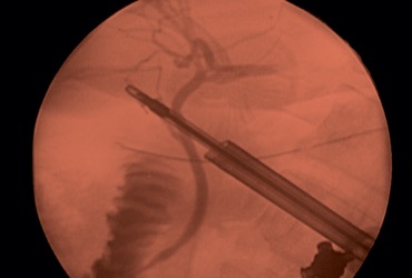 The Case for Routine Use of Intraoperative Cholangiography During ...