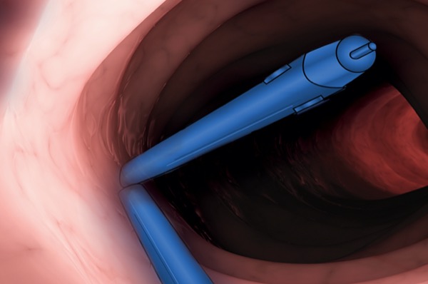 Polypectomy Clips Endoscopy Endoscopic Mucosal Resection Colorectal Polyps Polypectomy EMR