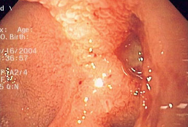 FDA Endoscopy Endoscopic Hemostasis System Nexpowder Medtronic