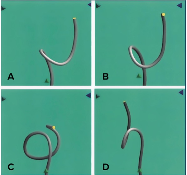 Splenic Injury in Colonoscopy