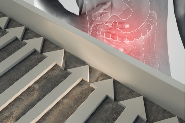 Therapeutic Ceiling Crohn's Disease Clinical Judgment Pediatric IBD