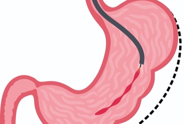 sl semaglutide Sublingual Semaglutide and weight loss