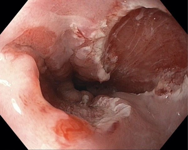 Barrett's Esophagus Management tp 10 FAQ