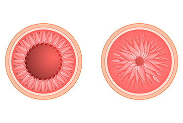 semaglutide and hiv Weekly Semaglutide Injection Reduces Liver Disease Severity in People with  HIV