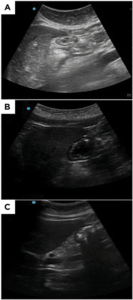 Perioperative Gastric Ultrasound Findings in GLP-1 Receptor Agonist Users