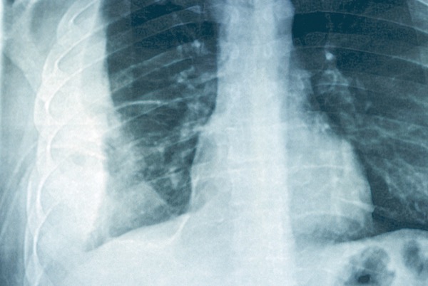 glp 1 market Market Overview: GLP-1 Agonists and the Obesity Market | Blog