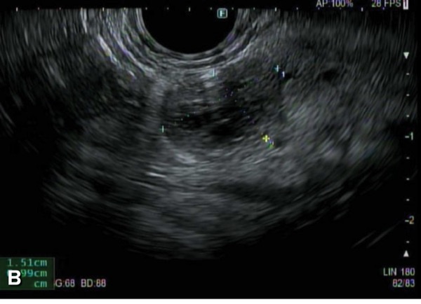 pancreas pancreatic cysts lesions imaging