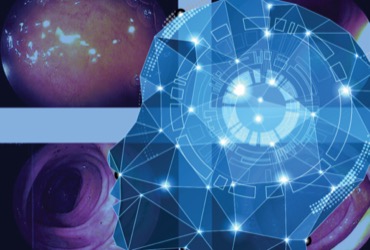 AI-Assisted Colonoscopy Enhances Benign Lesion Resection