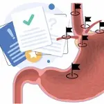 Fda Clearence Next Gen Pillcam Medtronic Capsule Endoscopy