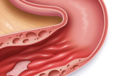 5 Steps to Treating a Suspected Obstruction in Crohn's Disease