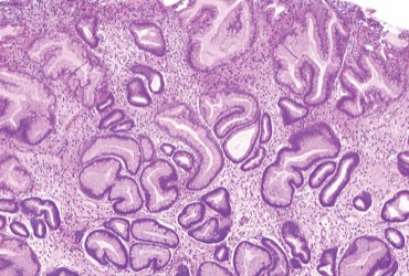 Managing Gastric Hyperplastic Polyps and Prophylactic Clipping