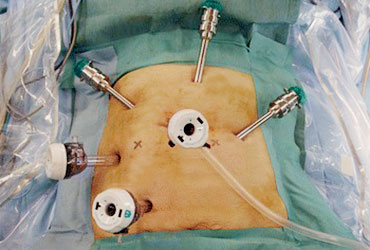 Robotic Surgery Improves 3-Year Relapse-Free Survival in Rectal Cancer