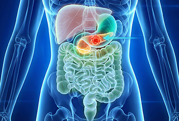 Radiomic Analysis Predicts Early Pancreatic Cancer Risk