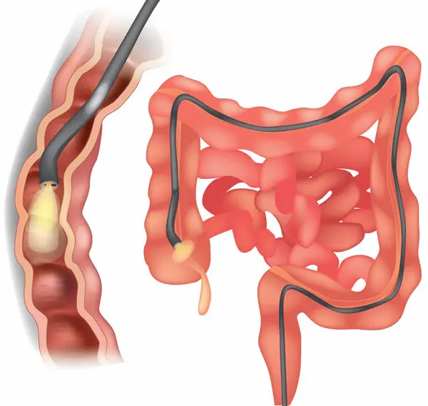 05260306-Decompressive-Colonoscopy Vs-Neostigmine Pseudobstruction AS238185740