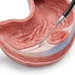 glp 1 colonoscopy GLP-1 ozempic semaglutide Colonoscopy bowel prep