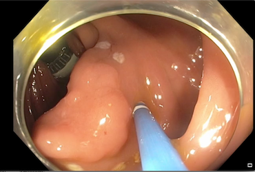  Double-balloon-endoscopy-overtube